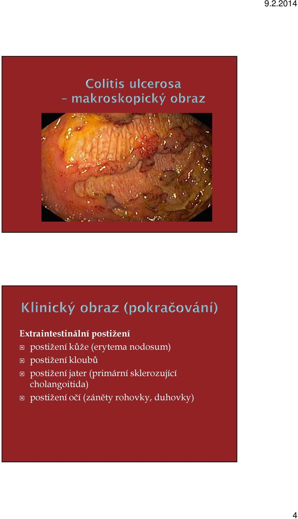 postižení jater (primární sklerozující