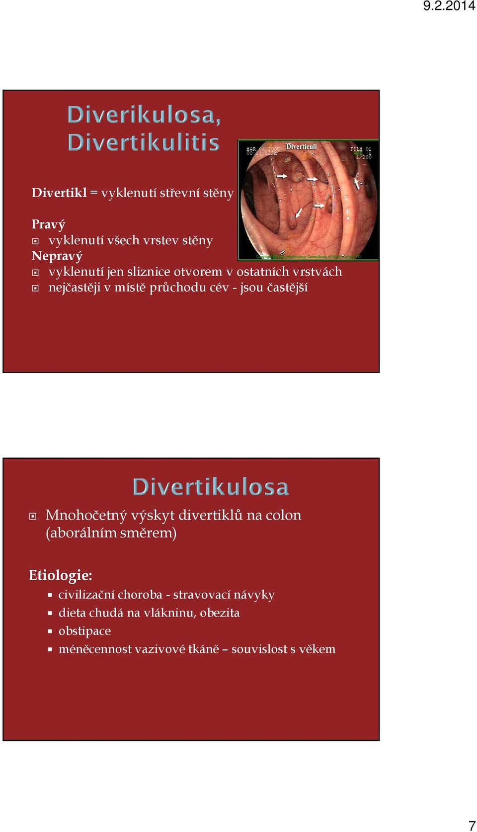 Mnohočetný výskyt divertiklů na colon (aborálním směrem) Etiologie: civilizační choroba -