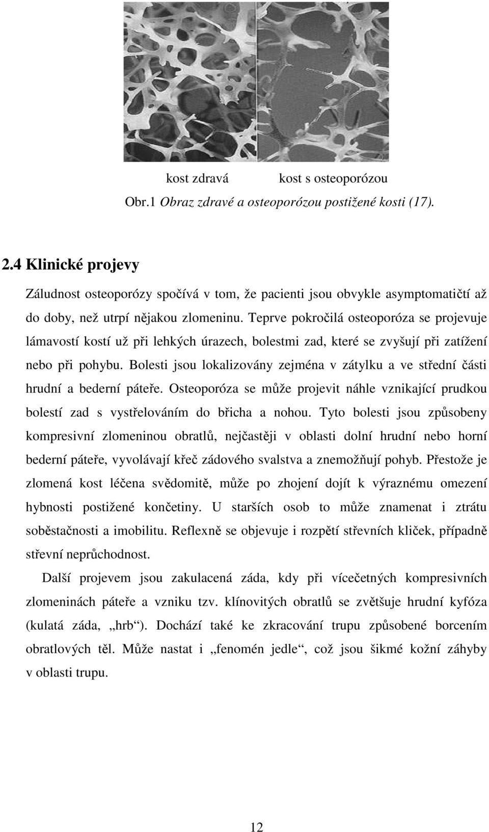 Teprve pokročilá osteoporóza se projevuje lámavostí kostí už při lehkých úrazech, bolestmi zad, které se zvyšují při zatížení nebo při pohybu.