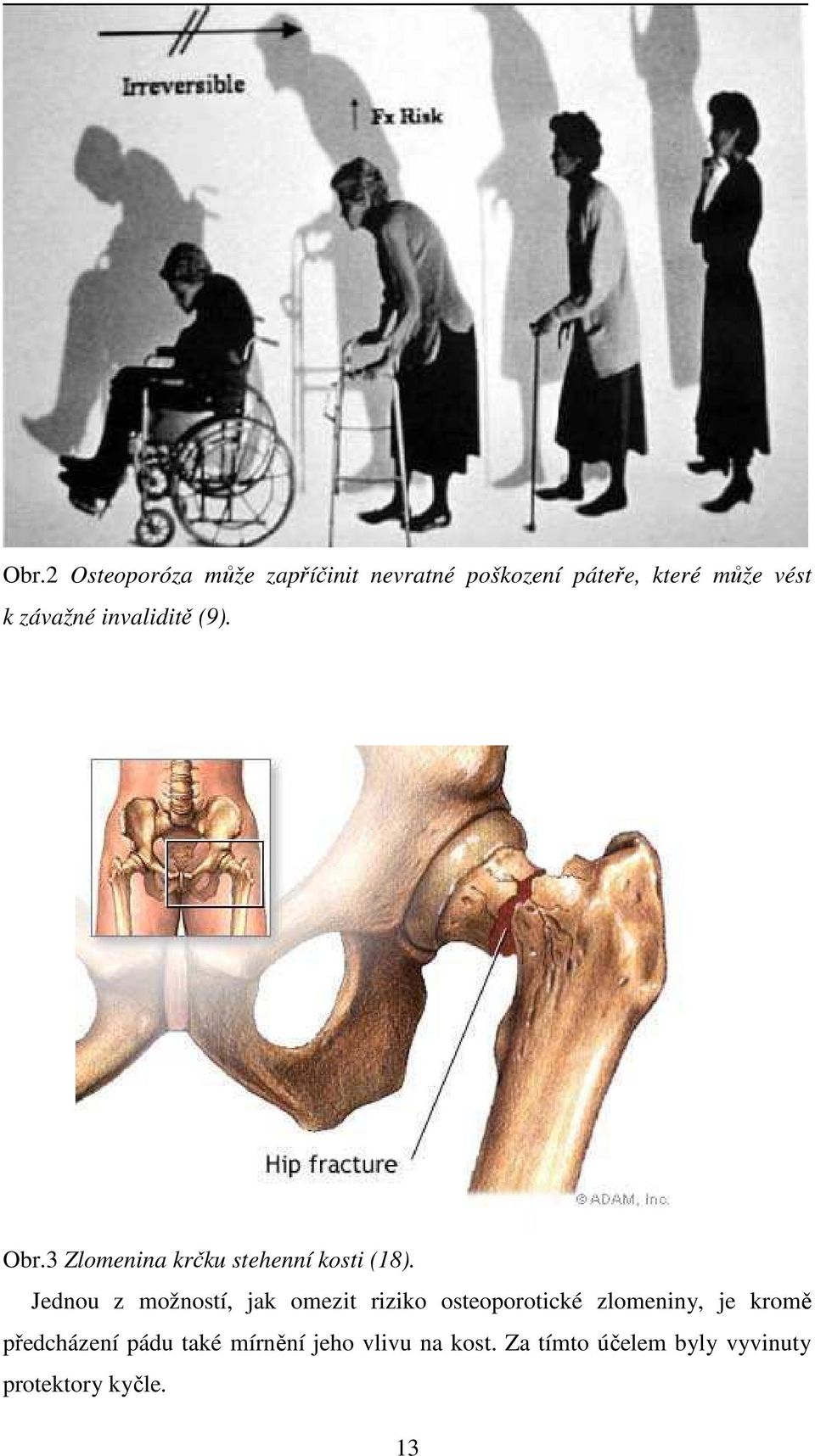 Jednou z možností, jak omezit riziko osteoporotické zlomeniny, je kromě