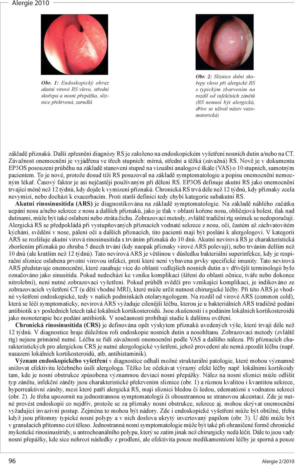 Další zpřesnění diagnózy RS je založeno na endoskopickém vyšetření nosních dutin a/nebo na CT. Závažnost onemocnění je vyjádřena ve třech stupních: mírná, střední a těžká (závažná) RS.