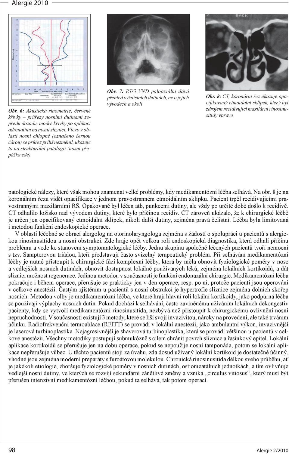 7: RTG VND poloaxiální dává přehled o čelistních dutinách, ne o jejich vývodech a okolí Obr.