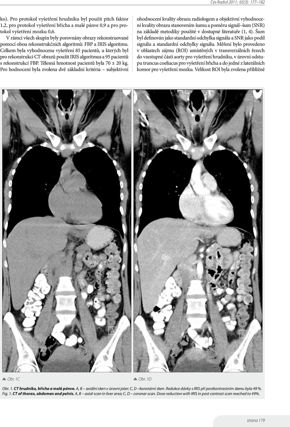 Celkem byla vyhodnocena vyšetření 85 pacientů, u kterých byl pro rekonstrukci CT obrazů použit IRIS algoritmus a 95 pacientů s rekonstrukcí FBP. Tělesná hmotnost pacientů byla 70 ± 20 kg.
