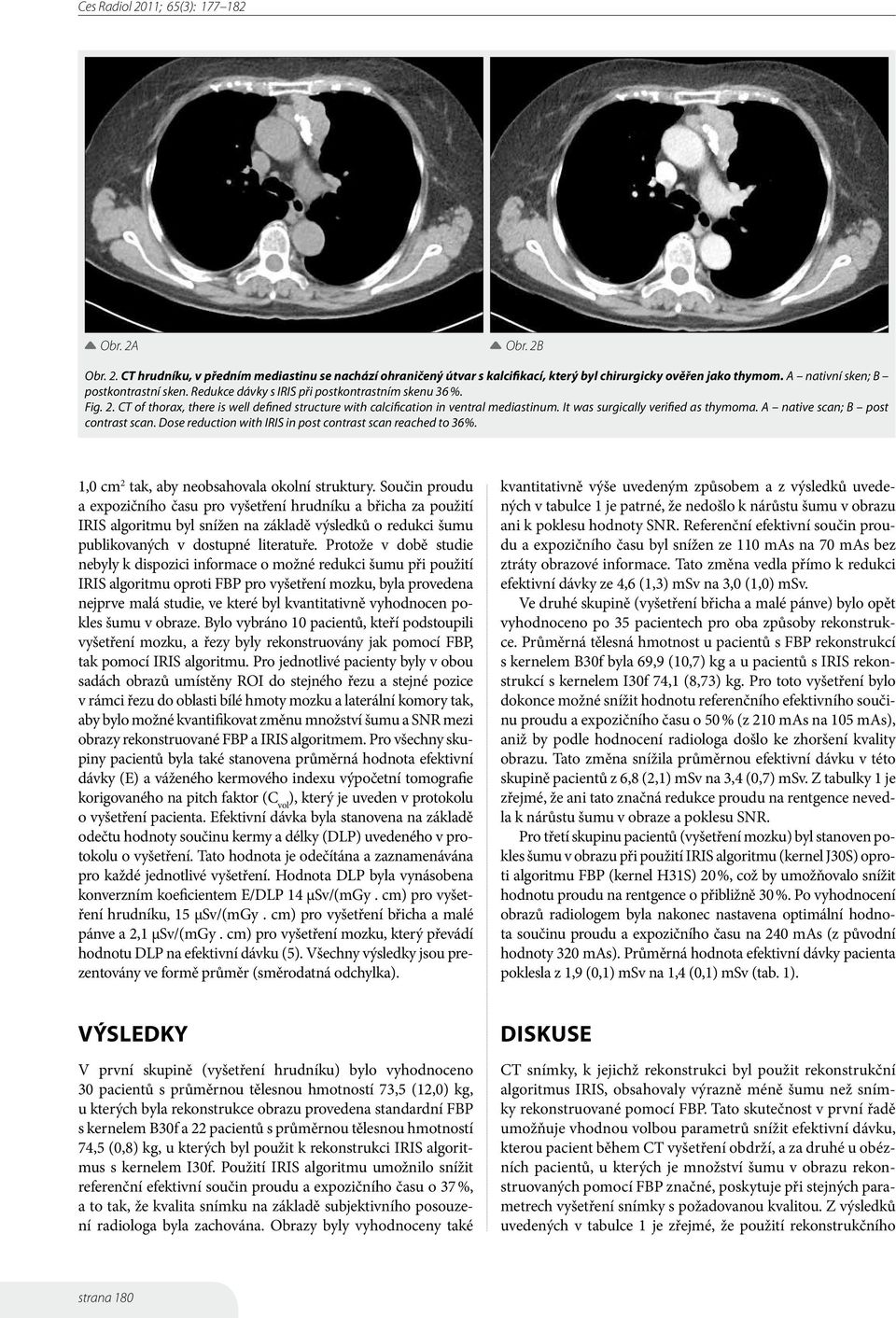 A native scan; B post contrast scan. Dose reduction with IRIS in post contrast scan reached to 36%. 1,0 cm 2 tak, aby neobsahovala okolní struktury.