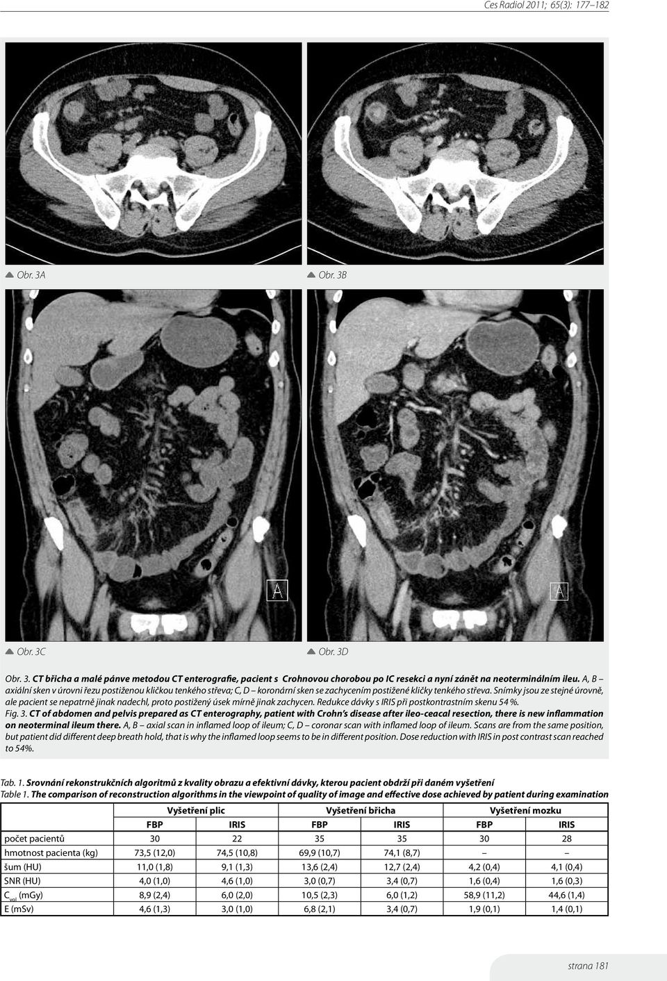 Snímky jsou ze stejné úrovně, ale pacient se nepatrně jinak nadechl, proto postižený úsek mírně jinak zachycen. Redukce dávky s IRIS při postkontrastním skenu 54 %. Fig. 3.