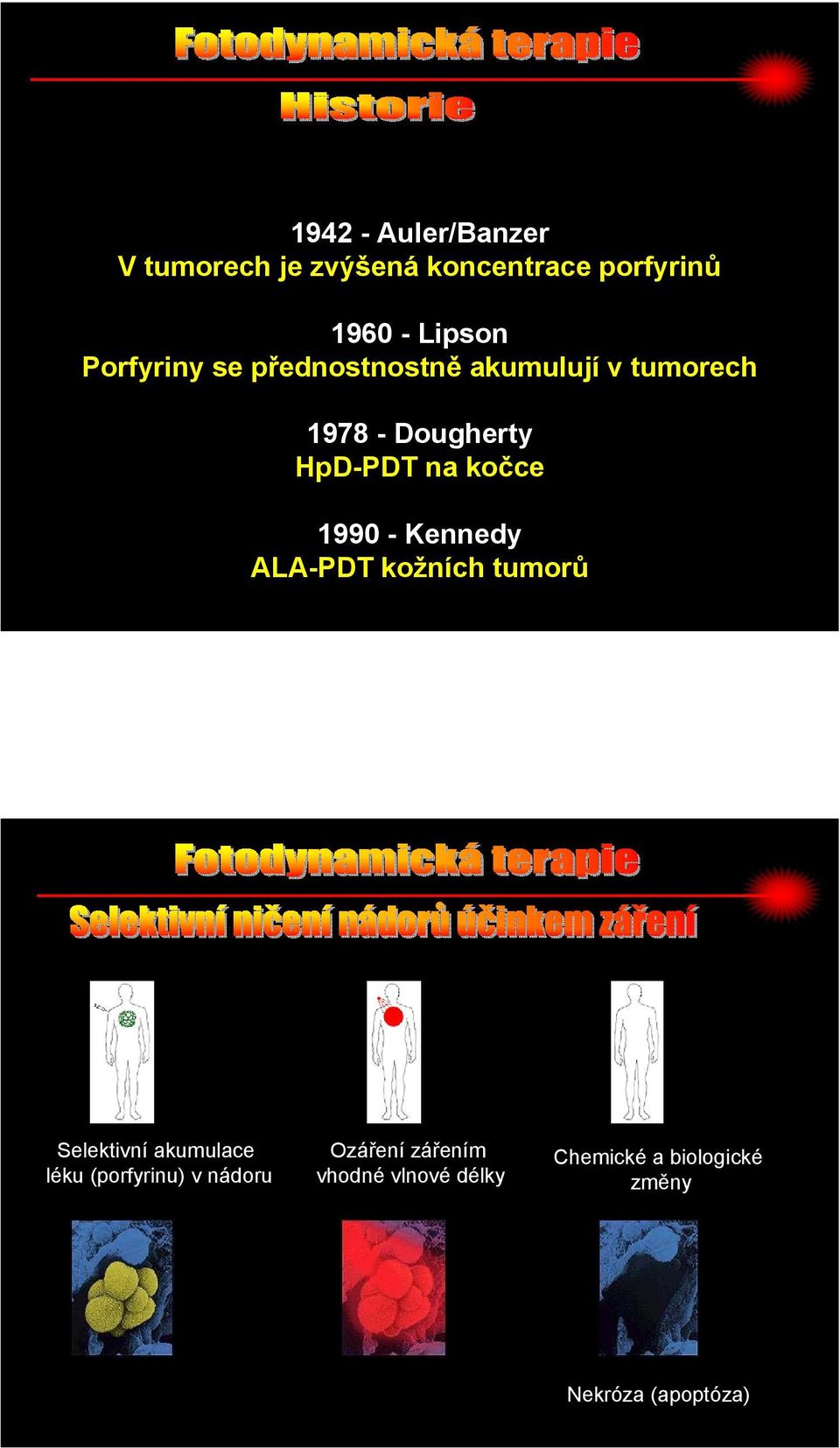 1990 - Kennedy ALA-PDT kožních tumorů Selektivní akumulace léku (porfyrinu) v