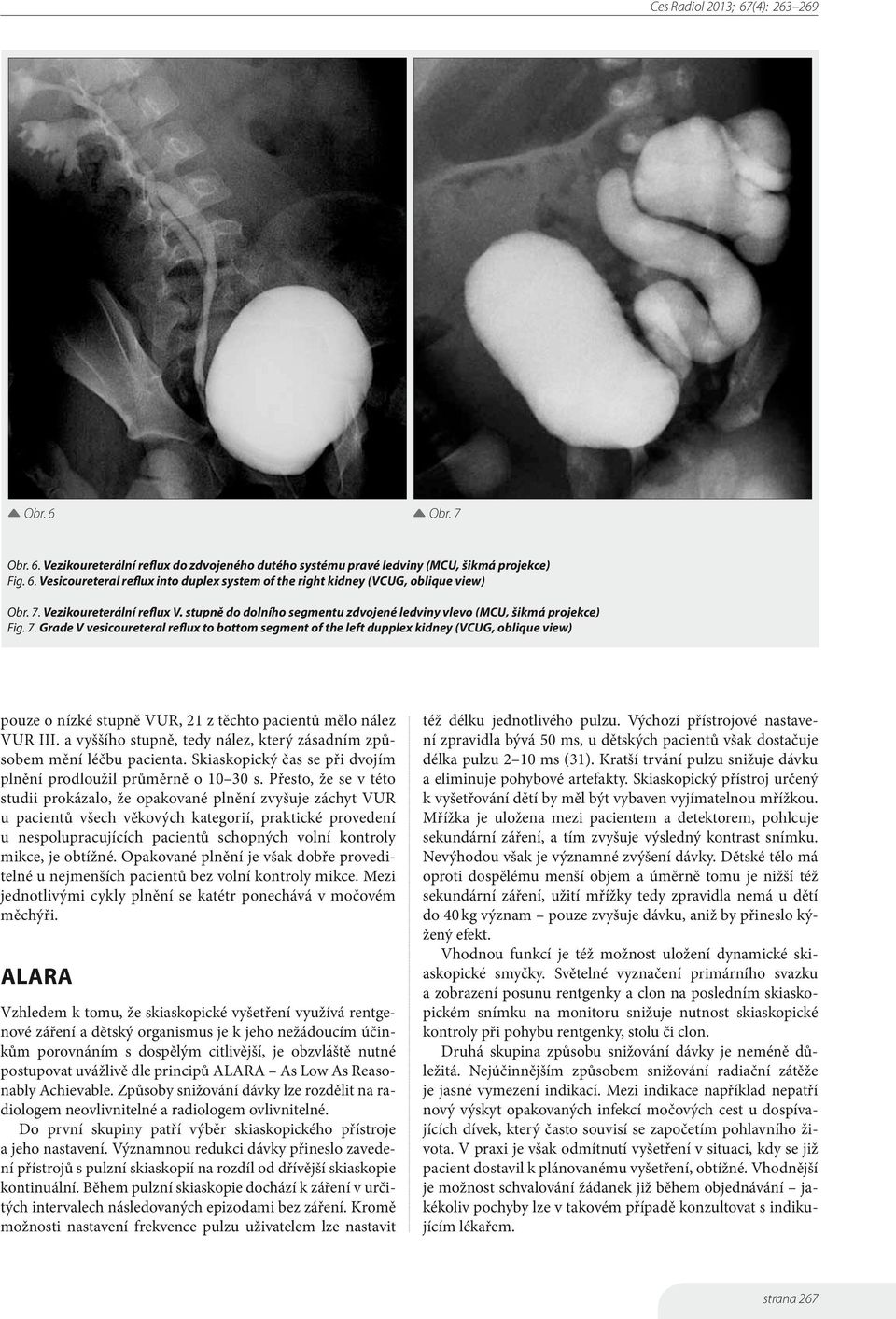 Grade V vesicoureteral reflux to bottom segment of the left dupplex kidney (VCUG, oblique view) pouze o nízké stupně VUR, 21 z těchto pacientů mělo nález VUR III.