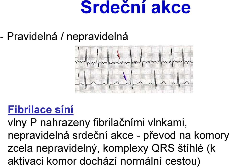 srdeční akce - převod na komory zcela nepravidelný,