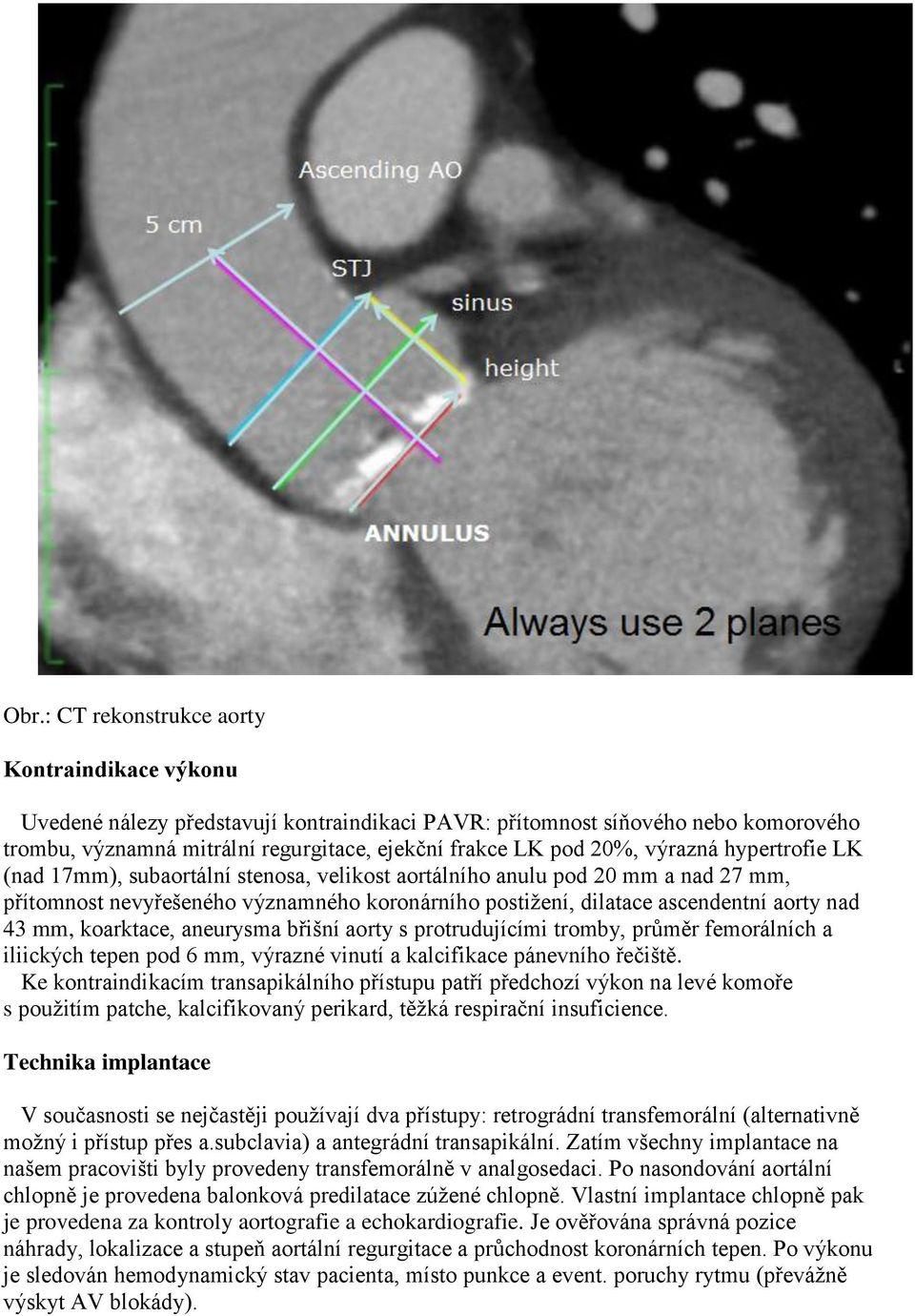 mm, koarktace, aneurysma břišní aorty s protrudujícími tromby, průměr femorálních a iliických tepen pod 6 mm, výrazné vinutí a kalcifikace pánevního řečiště.