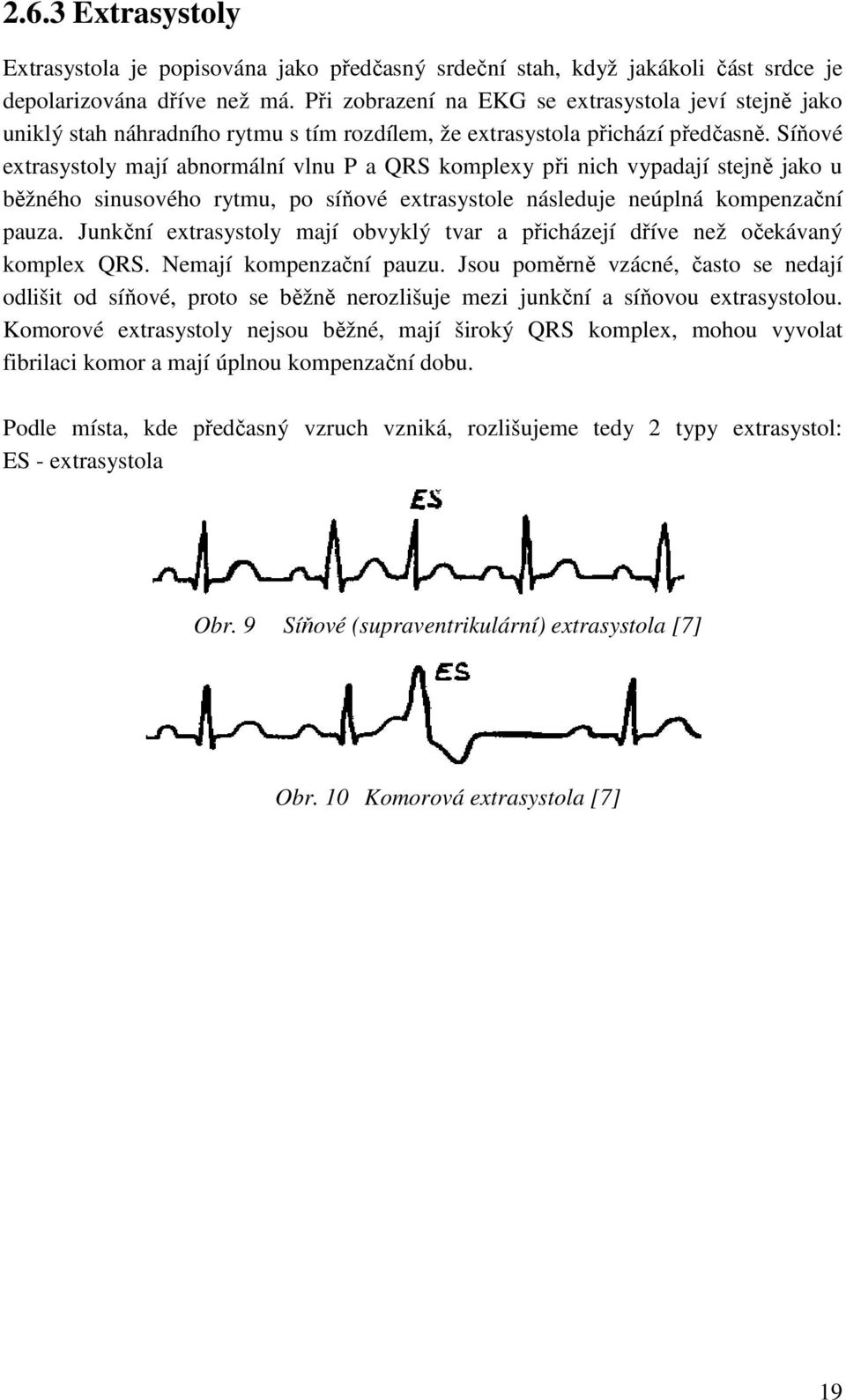 Síňové extrasystoly mají abnormální vlnu P a QRS komplexy při nich vypadají stejně jako u běžného sinusového rytmu, po síňové extrasystole následuje neúplná kompenzační pauza.