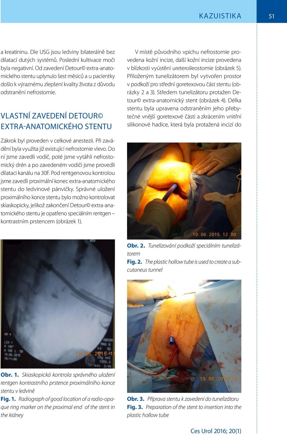 VLASTNÍ ZAVEDENÍ DETOUR EXTRA-ANATOMICKÉHO STENTU V místě původního vpichu nefrostomie provedena kožní incize, další kožní incize provedena v blízkosti vyústění ureteroileostomie (obrázek 5).