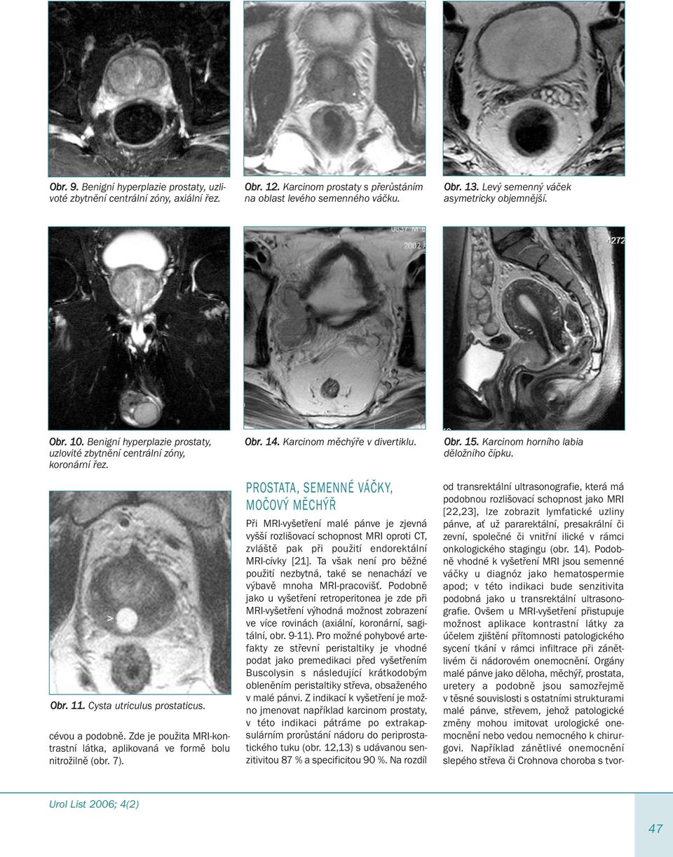 Zde je použita MRI-kontrastní látka, aplikovaná ve formě bolu nitrožilně (obr. 7). Obr. 14. Karcinom měchýře v divertiklu.