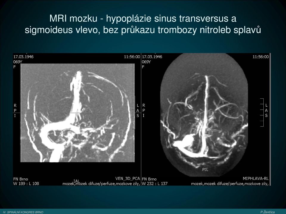 sigmoideus vlevo, bez