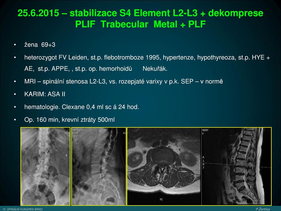 p.. op. hemorhoidů Nekuřák. MRI spinální stenosa L2-L3, vs. rozepjaté varixy v p.k.. SEP v normě KARIM: ASA II hematologie.