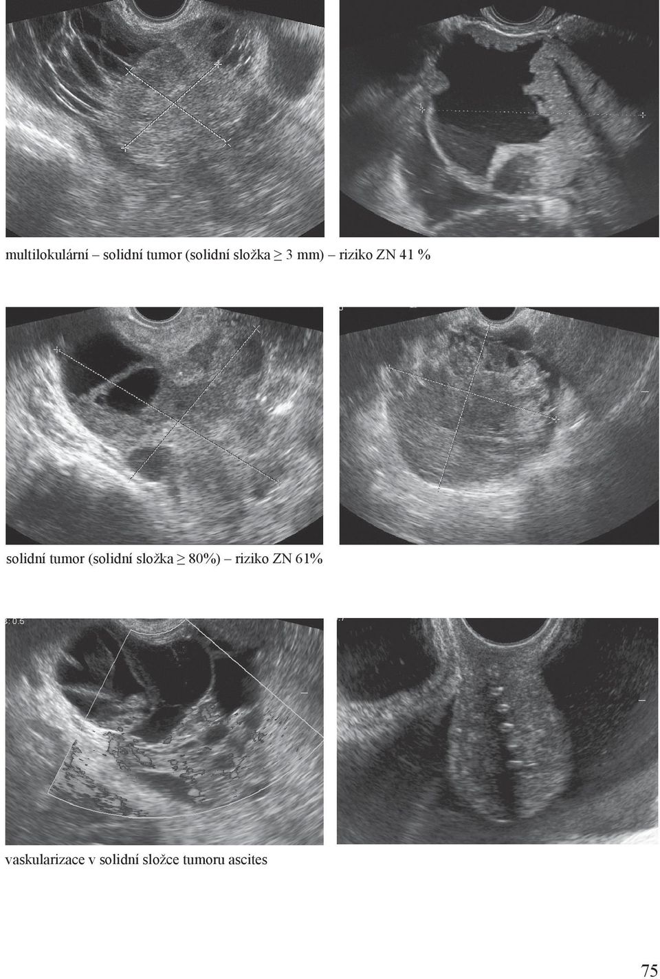 tumor (solidní složka 80%) riziko ZN 61%