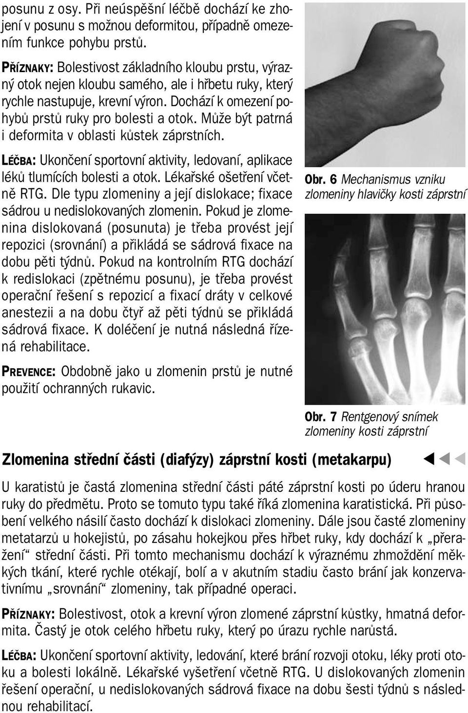 Může být patrná i deformita v oblasti kůstek záprstních. LÉČBA: Ukončení sportovní aktivity, ledovaní, aplikace léků tlumících bolesti a otok. Lékařské ošetření včet ně RTG.