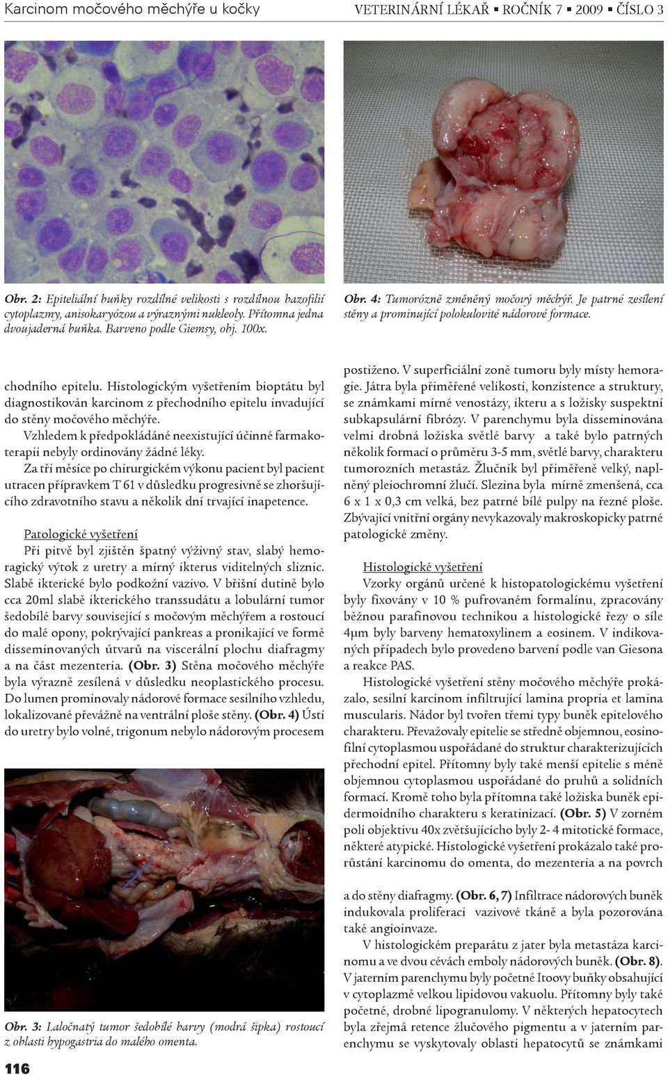 Histologickým vyšetøením bioptátu byl diagnostikován karcinom z pøechodního epitelu invadující do stìny moèového mìchýøe.