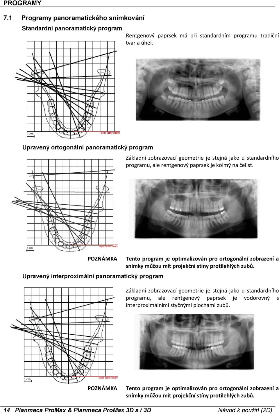 Upravený interproximální panoramatický program Tento program je optimalizován pro ortogonální zobrazení a snímky můžou mít projekční stíny protilehlých zubů.