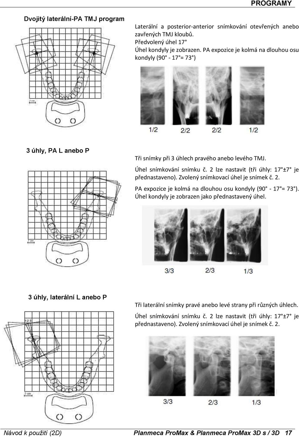 2 lze nastavit (tři úhly: 17 ±7 je přednastaveno). Zvolený snímkovací úhel je snímek č. 2. PA expozice je kolmá na dlouhou osu kondyly (90-17 = 73 ). Úhel kondyly je zobrazen jako přednastavený úhel.