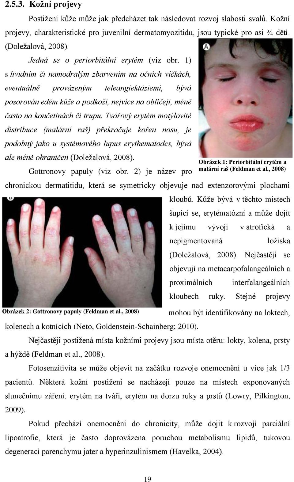 1) s lividním či namodralým zbarvením na očních víčkách, eventuálně provázeným teleangiektáziemi, bývá pozorován edém kůže a podkoží, nejvíce na obličeji, méně často na končetinách či trupu.