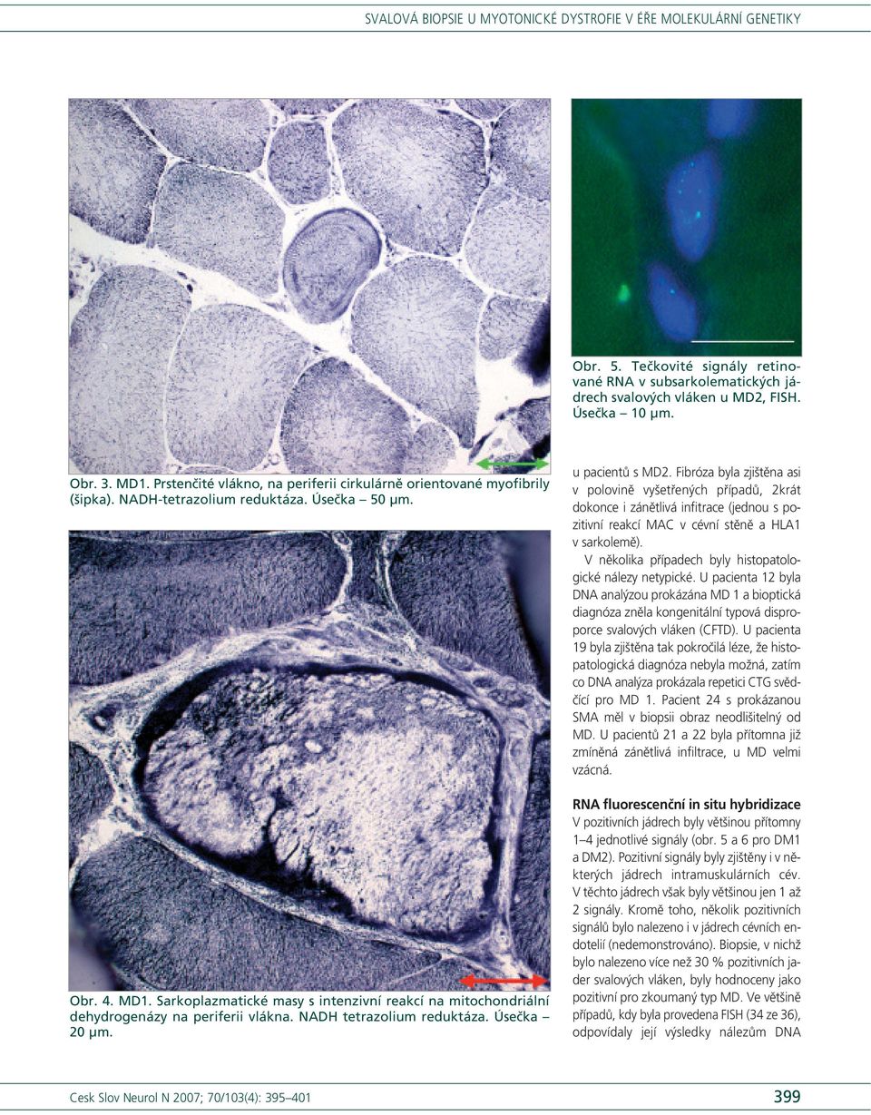 Sarkoplazmatické masy s intenzivní reakcí na mitochondriální dehydrogenázy na periferii vlákna. NADH tetrazolium reduktáza. Úsečka 20 μm. u pacientů s MD2.