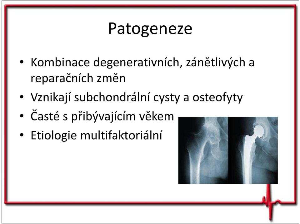 subchondrální cysty a osteofyty Časté s