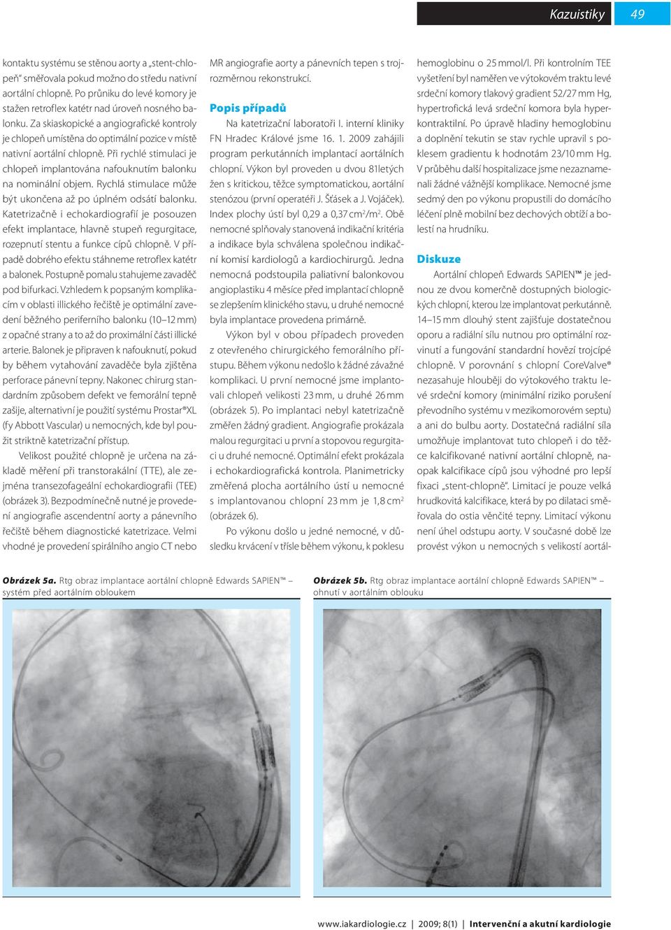 Rychlá stimulace může být ukončena až po úplném odsátí balonku. Katetrizačně i echokardiografií je posouzen efekt implantace, hlavně stupeň regurgitace, rozepnutí stentu a funkce cípů chlopně.