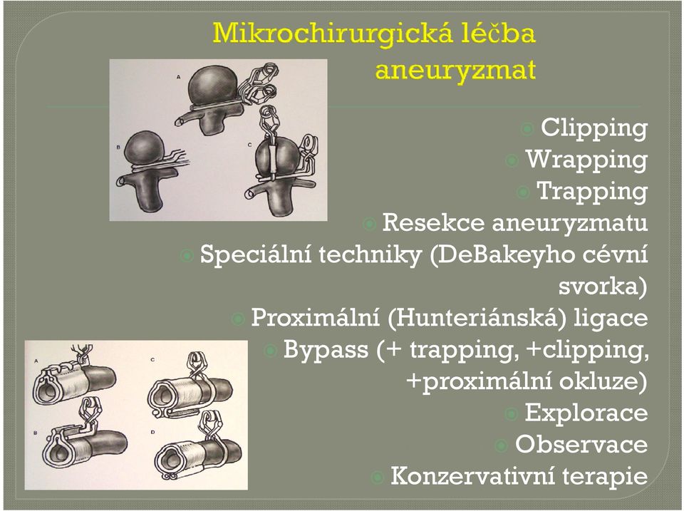 Proximální (Hunteriánská) ligace Bypass (+ trapping,