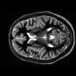 Spin-echo sekvence (SE) Spin echo sekvence (SE): - budicí 90 RF puls, refokusační 180 RF puls - detekce signálu: spin-echo - Single echo - SE, DSE,