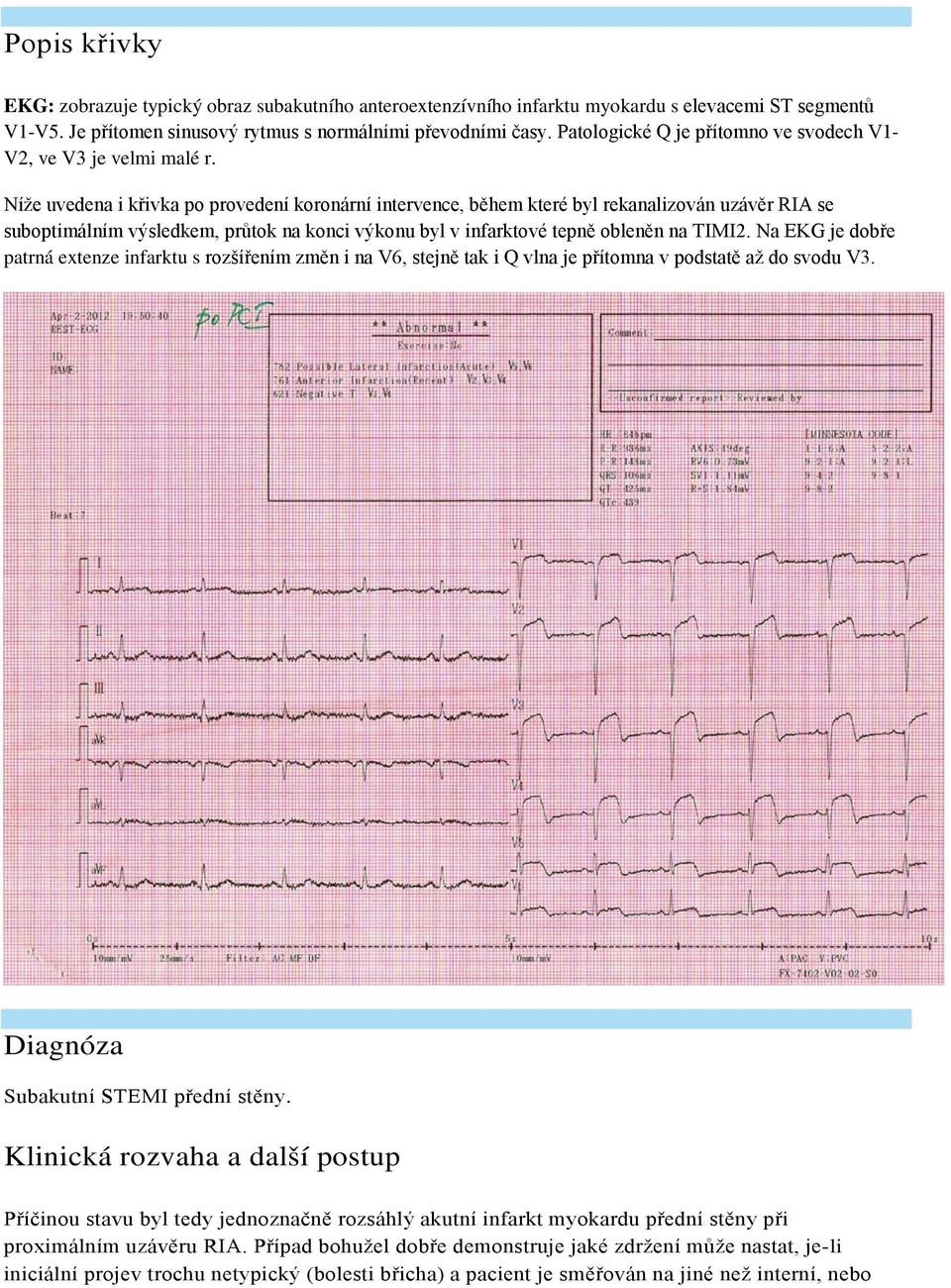 Níže uvedena i křivka po provedení koronární intervence, během které byl rekanalizován uzávěr RIA se suboptimálním výsledkem, průtok na konci výkonu byl v infarktové tepně obleněn na TIMI2.