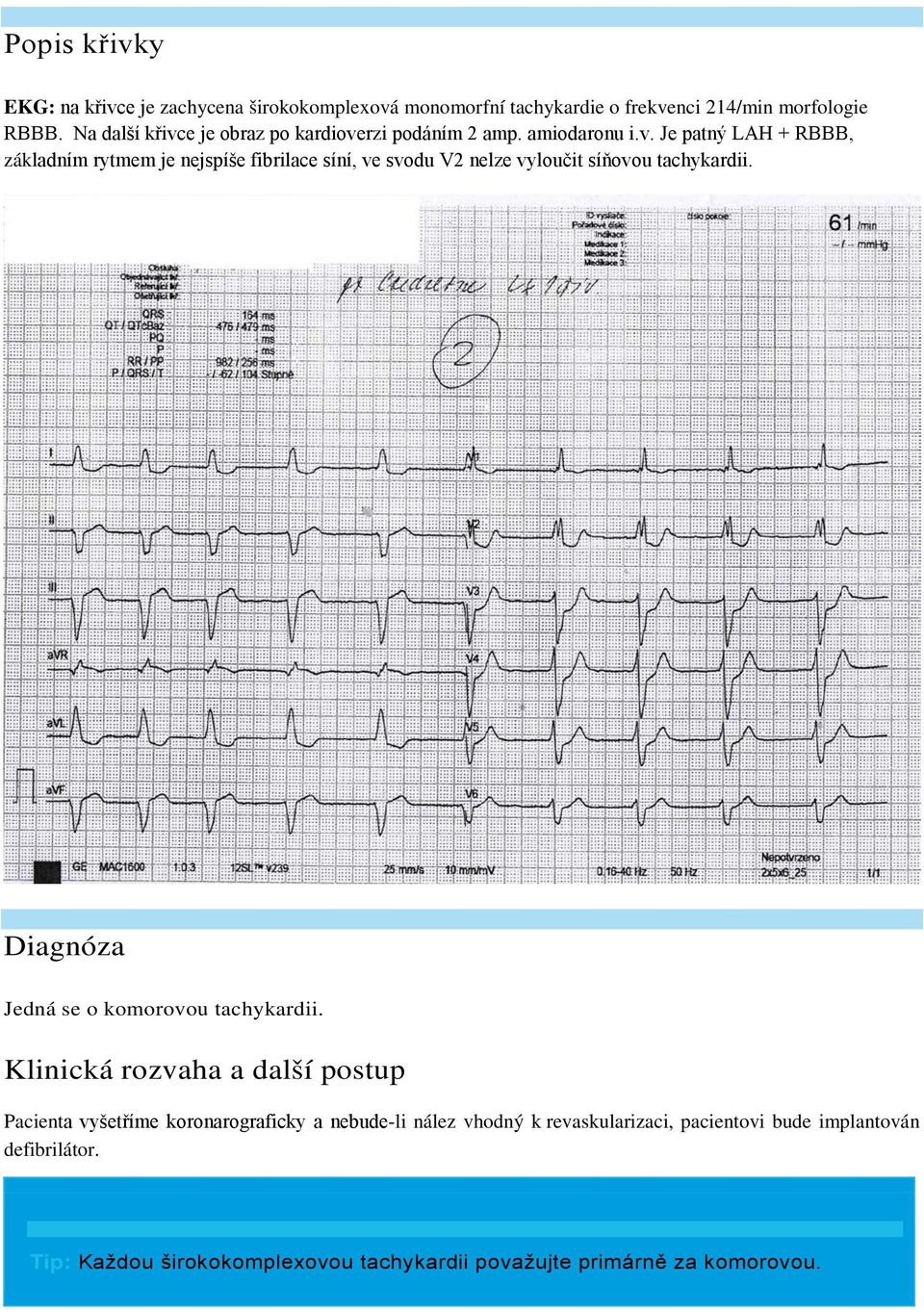 Diagnóza Jedná se o komorovou tachykardii.