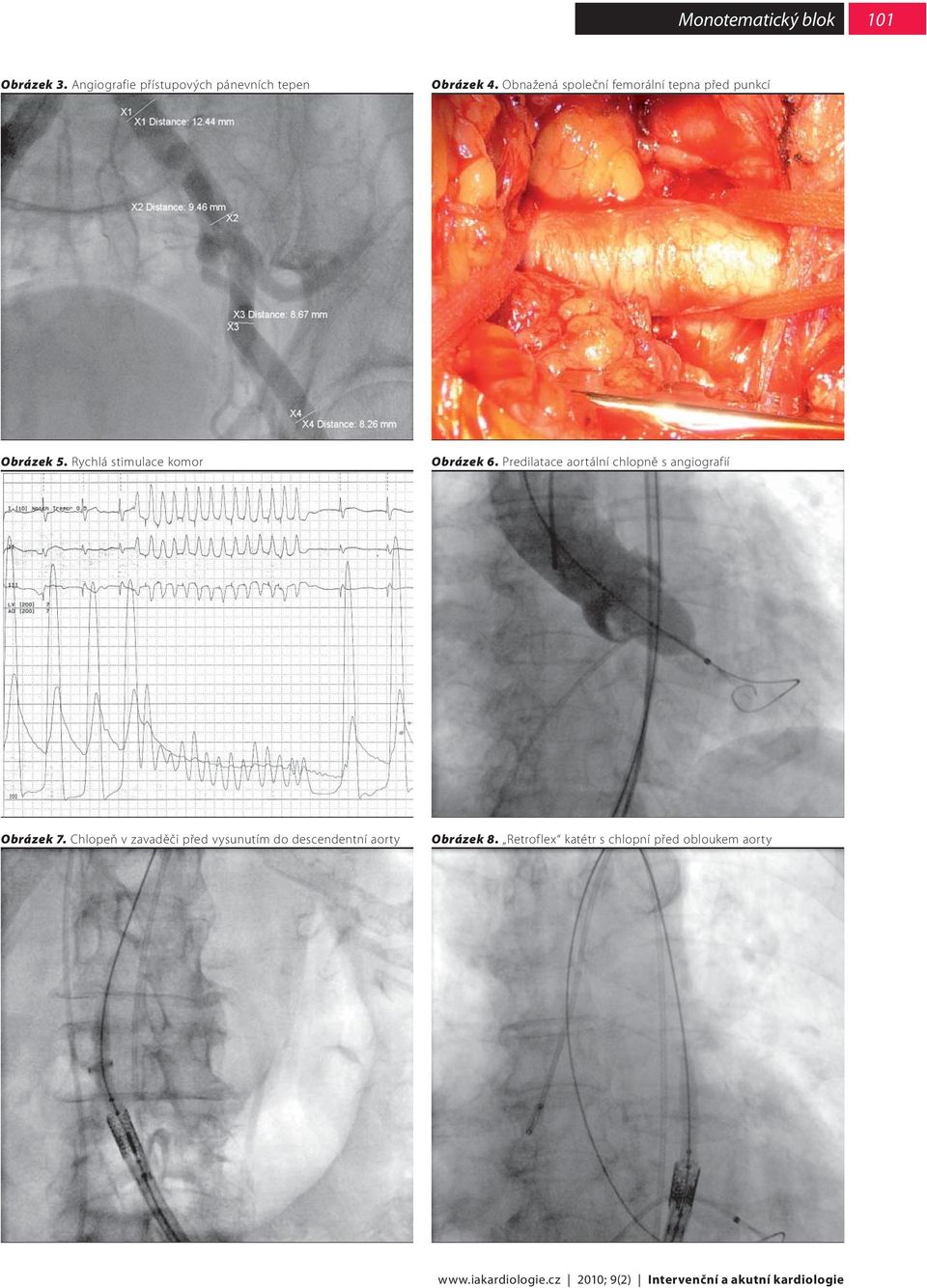 Predilatace aortální chlopně s angiografií Obrázek 7.