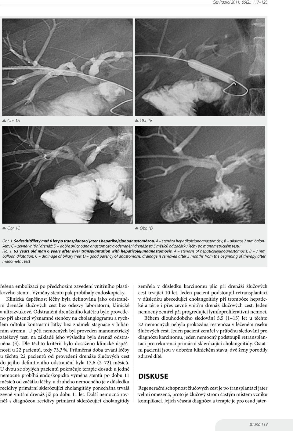 63 years old man 6 years after liver transplantation with hepaticojejunoanastomosis.