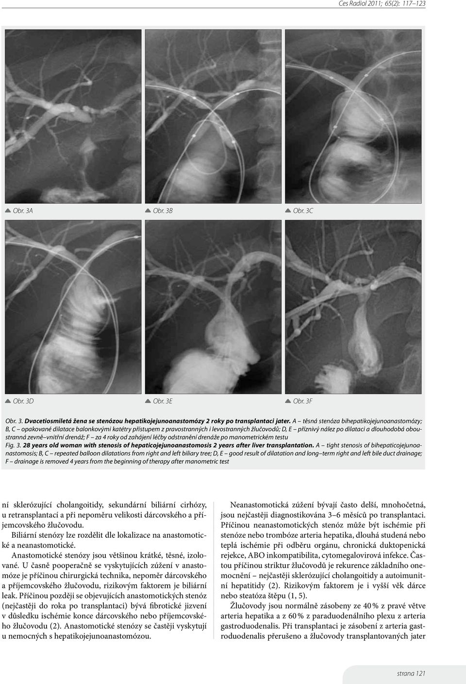 zevně vnitřní drenáž; F za 4 roky od zahájení léčby odstranění drenáže po manometrickém testu Fig. 3. 28 years old woman with stenosis of hepaticojejunoanastomosis 2 years after liver transplantation.