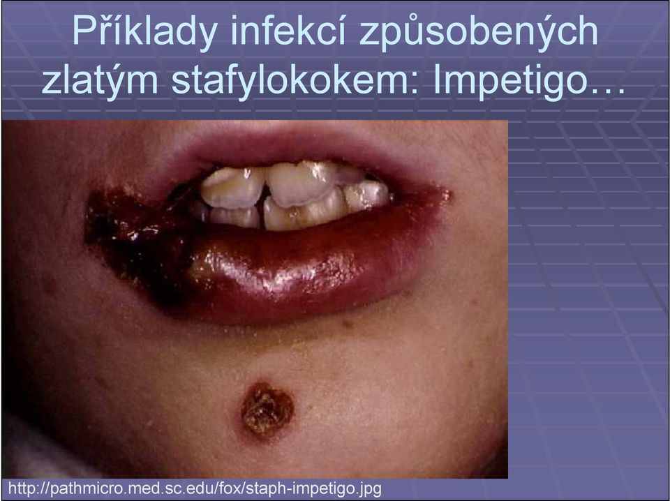 stafylokokem: Impetigo