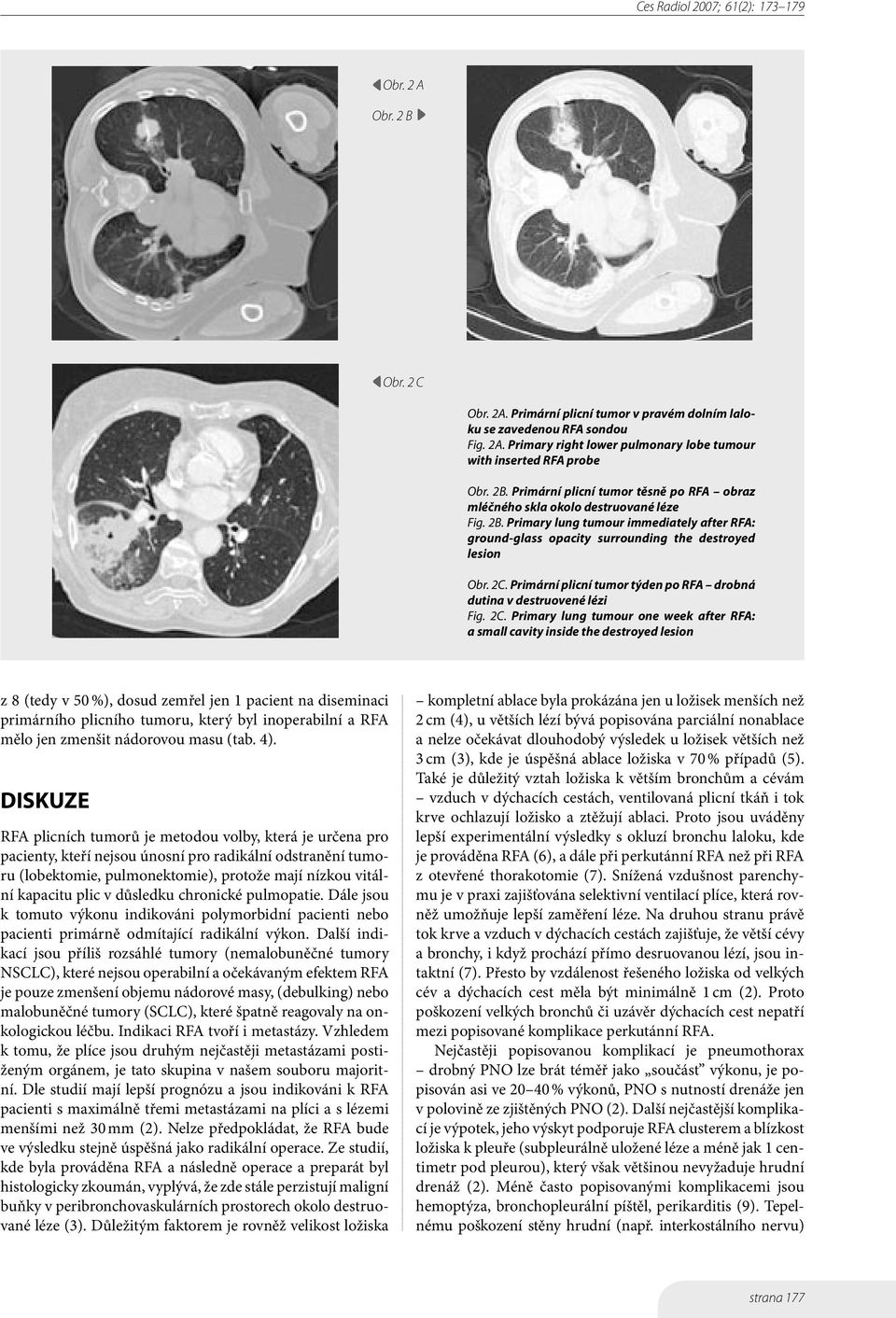 Primární plicní tumor týden po RFA drobná dutina v destruovené lézi Fig. 2C.