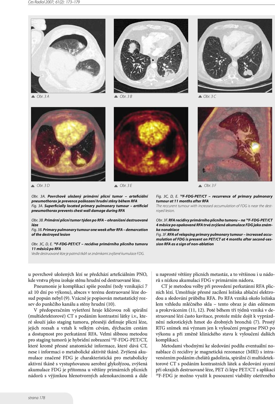 F-FDG-PET/CT recidiva primárního plicního tumoru 11 měsíců po RFA Vedle destruované léze je patrná tkáň se známkami zvýšené kumulace FDG. Fig. 3C, D, E.