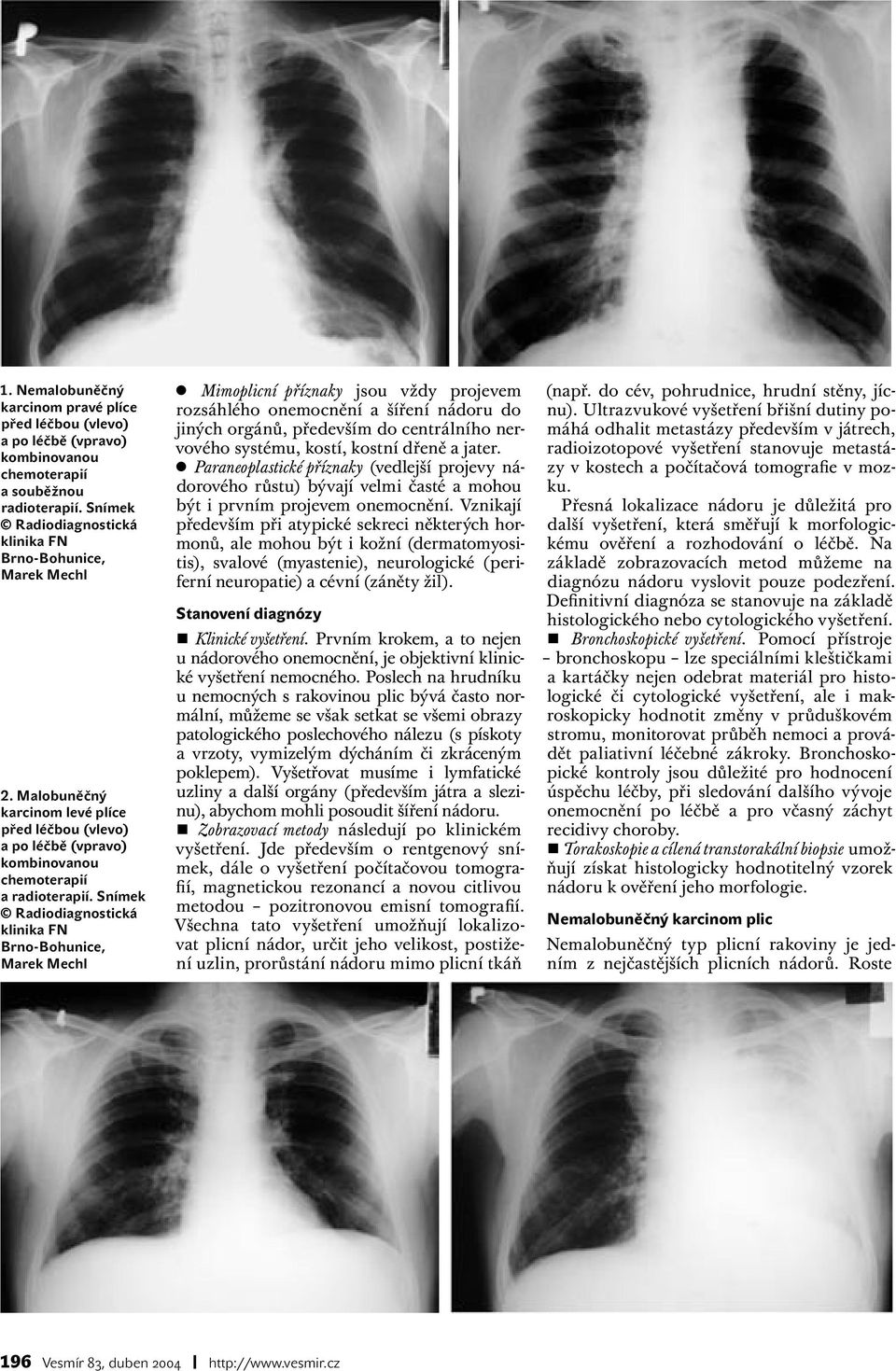 Snímek Radiodiagnostická klinika FN Marek Mechl Mimoplicní příznaky jsou vždy projevem rozsáhlého onemocnění a šíření nádoru do jiných orgánů, především do centrálního nervového systému, kostí,