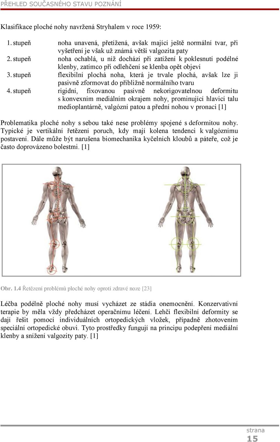 stupeň noha ochablá, u níž dochází při zatížení k poklesnutí podélné klenby, zatímco při odlehčení se klenba opět objeví 3.