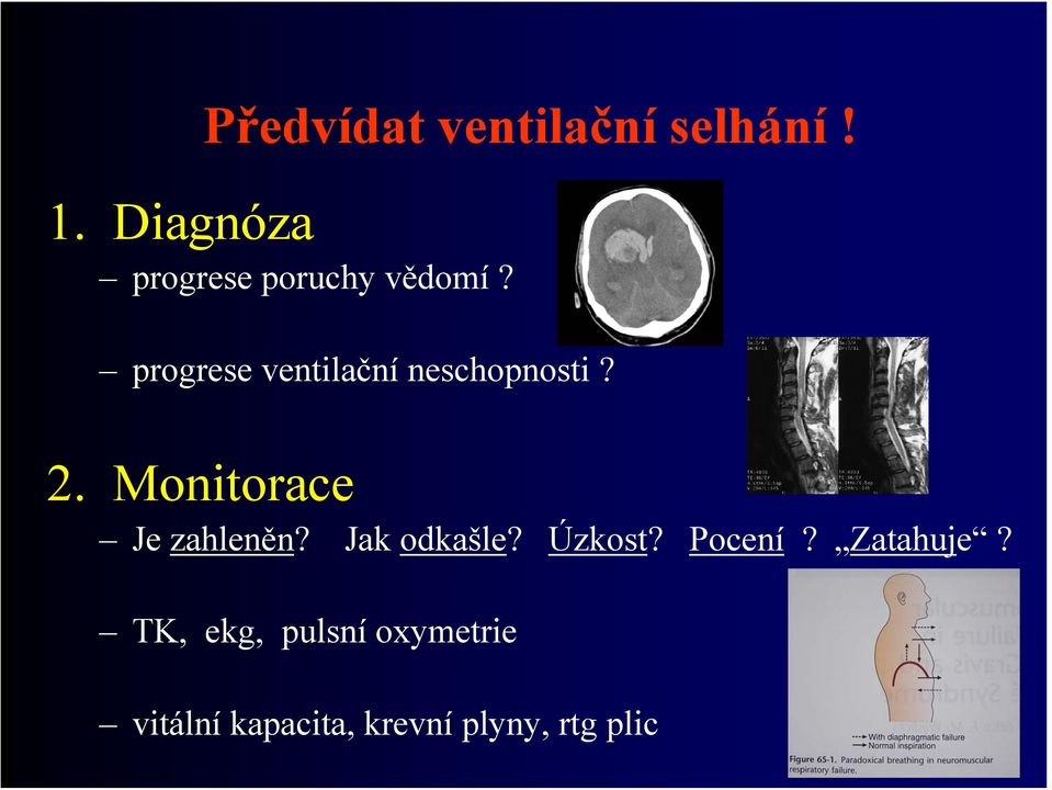 progrese ventilační neschopnosti? 2.