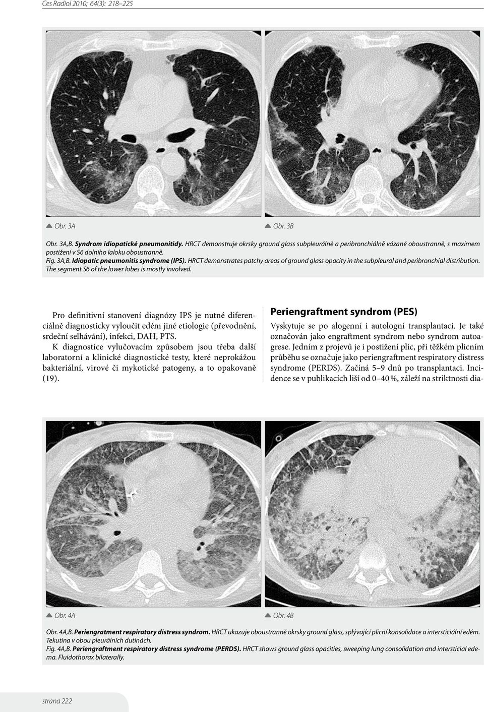 HRCT demonstrates patchy areas of ground glass opacity in the subpleural and peribronchial distribution. The segment S6 of the lower lobes is mostly involved.