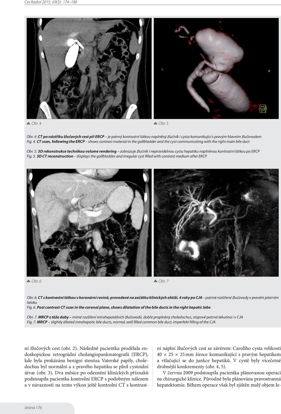 3D CT reconstruction displays the gallbladder and irregular cyst filled with contrast medium after ERCP Obr. 6 