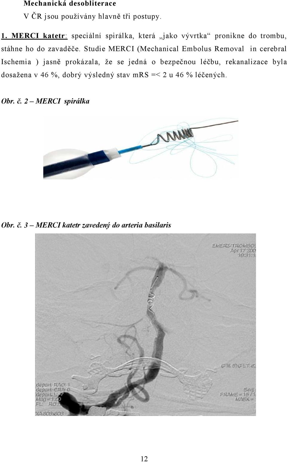 Studie MERCI (Mechanical Embolus Removal in cerebral Ischemia ) jasně prokázala, že se jedná o bezpečnou