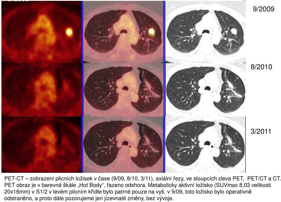 Metabolicky aktivní ložisko (SUVmax 8,03 velikosti 20x16mm) v S1/2 v levém plicním křídle bylo patrné