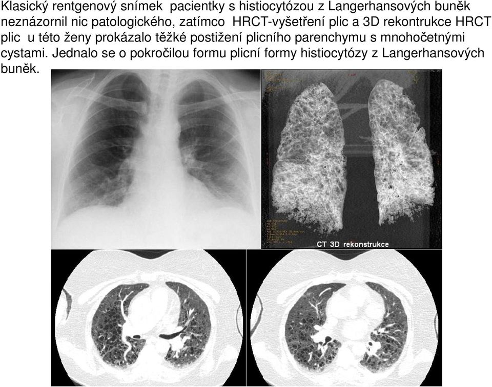 plic u této ženy prokázalo těžké postižení plicního parenchymu s mnohočetnými