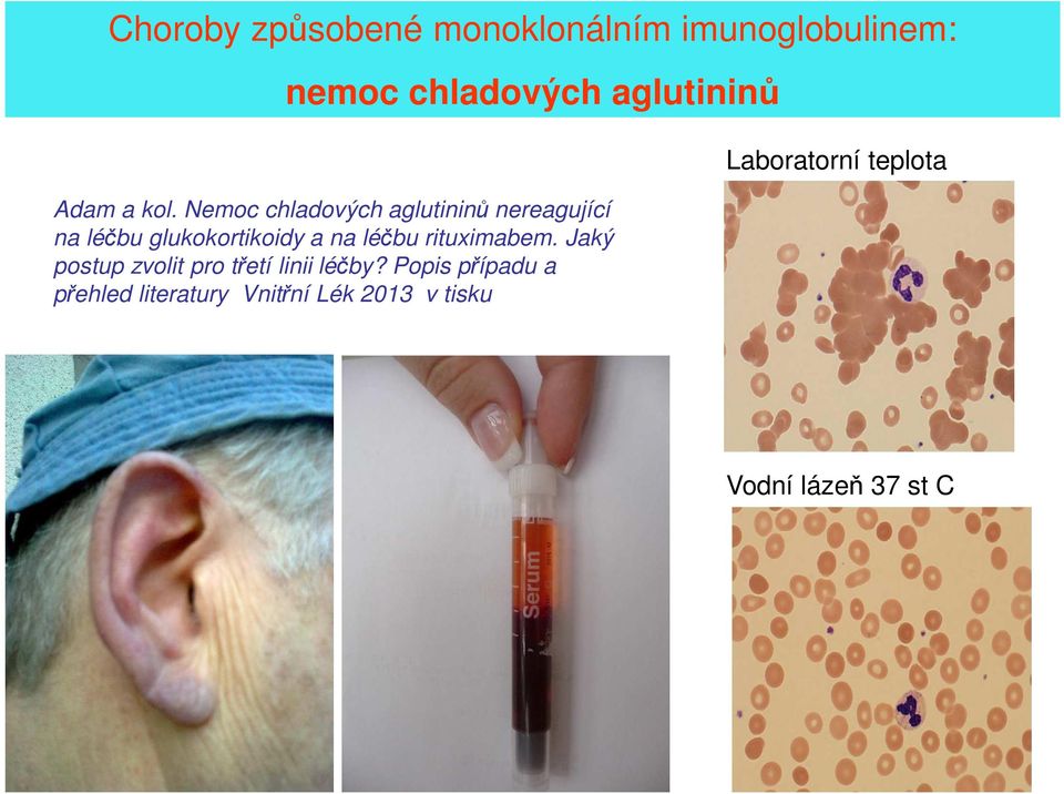 Nemoc chladových aglutininů nereagující na léčbu glukokortikoidy a na léčbu