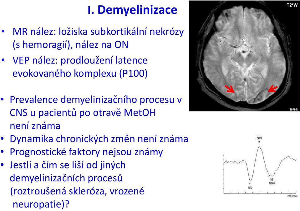 pacientů po otravě MetOH není známa Dynamika chronických změn není známa Prognostické faktory