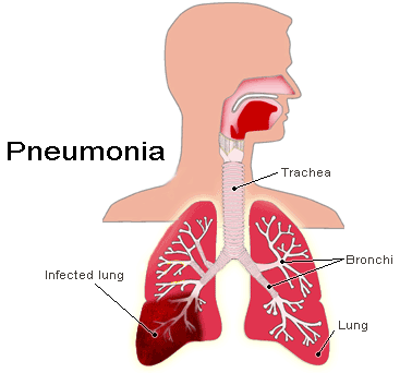 Infekce plic - pneumonie Komunitní u dospělých: S. pneumoniae, S. aureus, H. influenzae, M. pneumoniae, Ch.