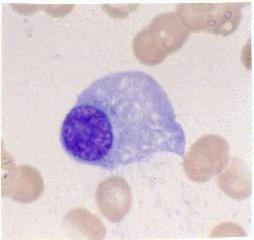 Morfologie MM bb nezralé myelomové bb: VLA-5 - MCP-1 - středně