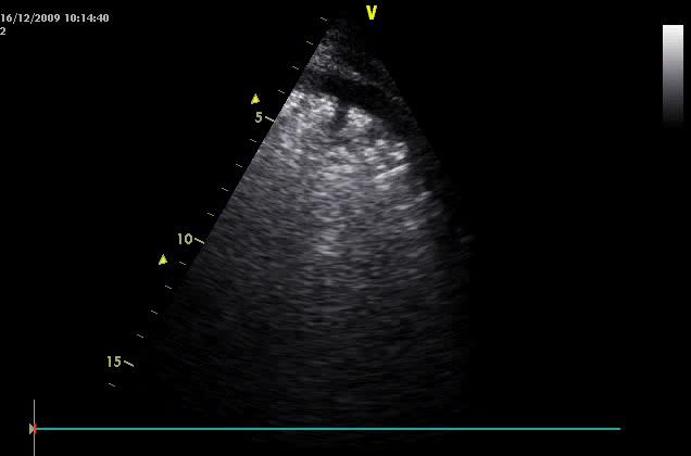 Hrudní ultrasonografie Je rychlá (FAST) s okamžitou aplikací pro terapii pac.